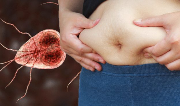 Triglycerides  ldl  hdl  cholesterol Abdominal bloating: Your swelling could also signify this underlying situation – are you at wretchedness? – Express